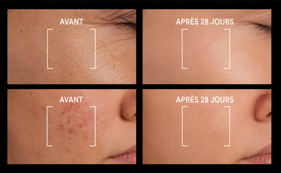 Résultat avant après soin de nuit